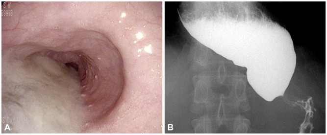 Aclazia - simptome, diagnostic si optiuni de tratament