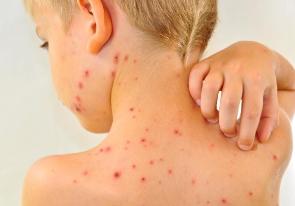 Varicela: Simptome, prevenție și tratament