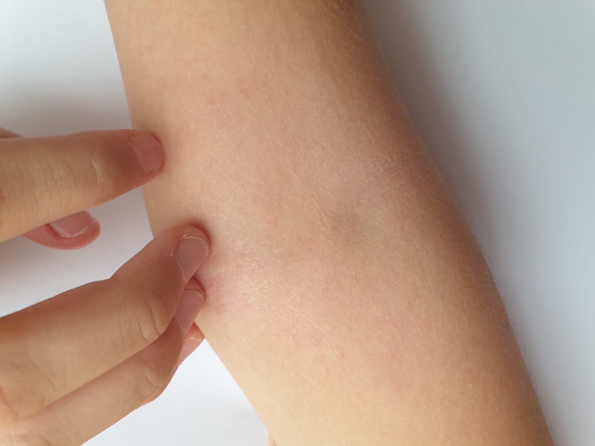 Dermatita de contact